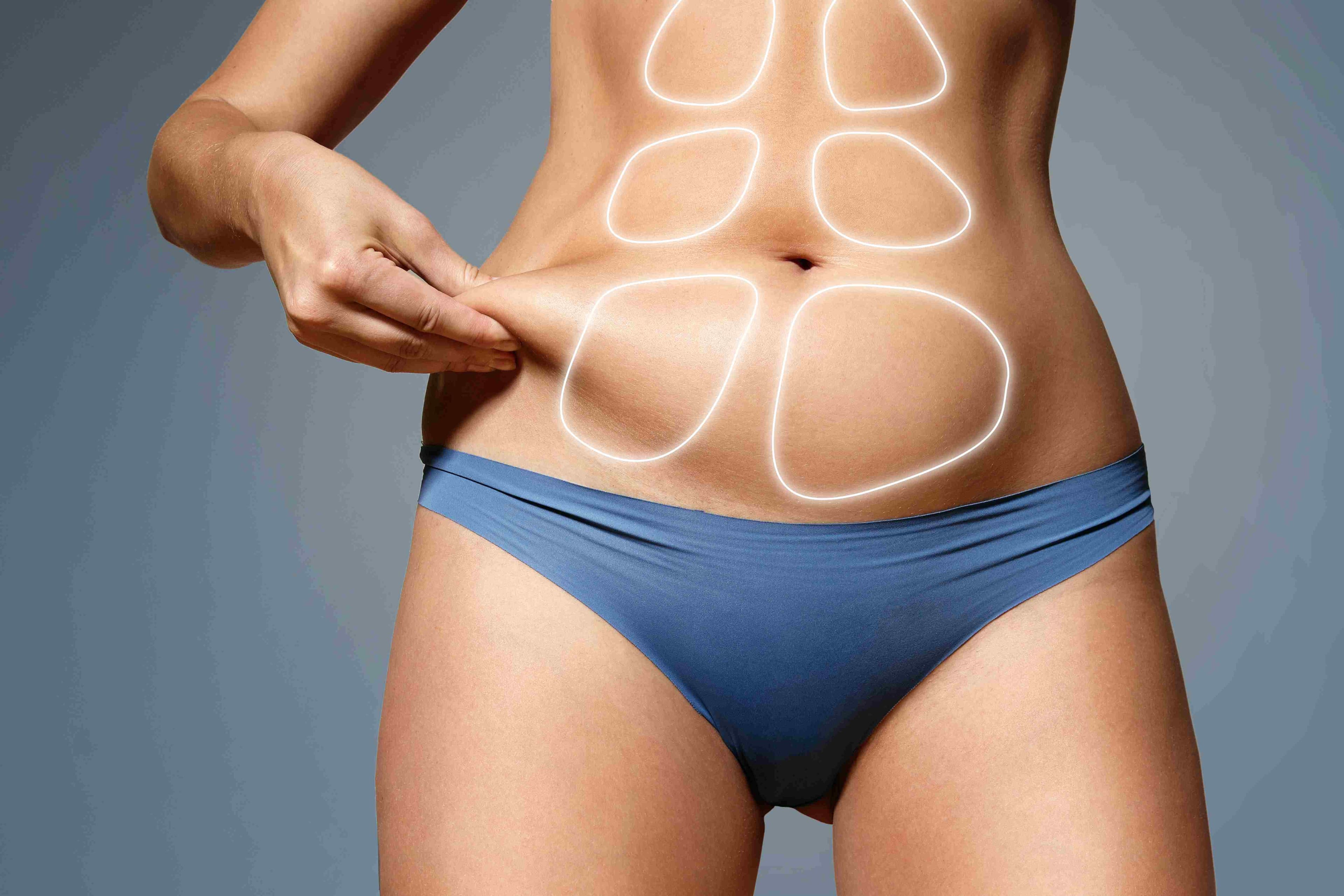Abdominoplastie avec liposuccion du ventre