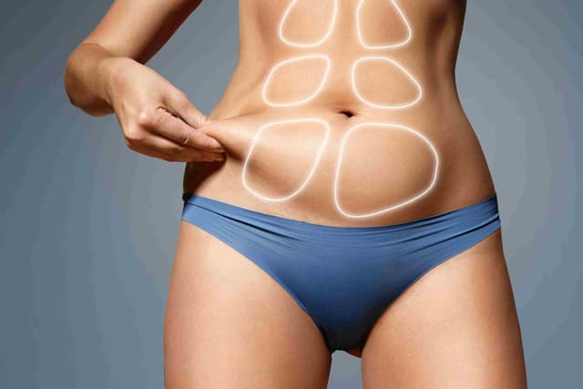 Abdominoplastie avec liposuccion du ventre