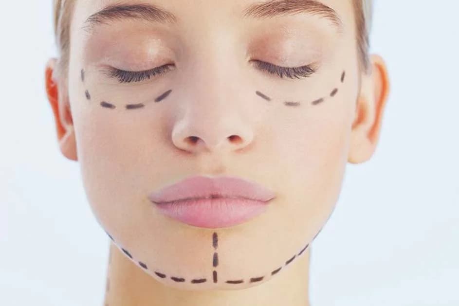 Lifting de visage et fils tenseurs