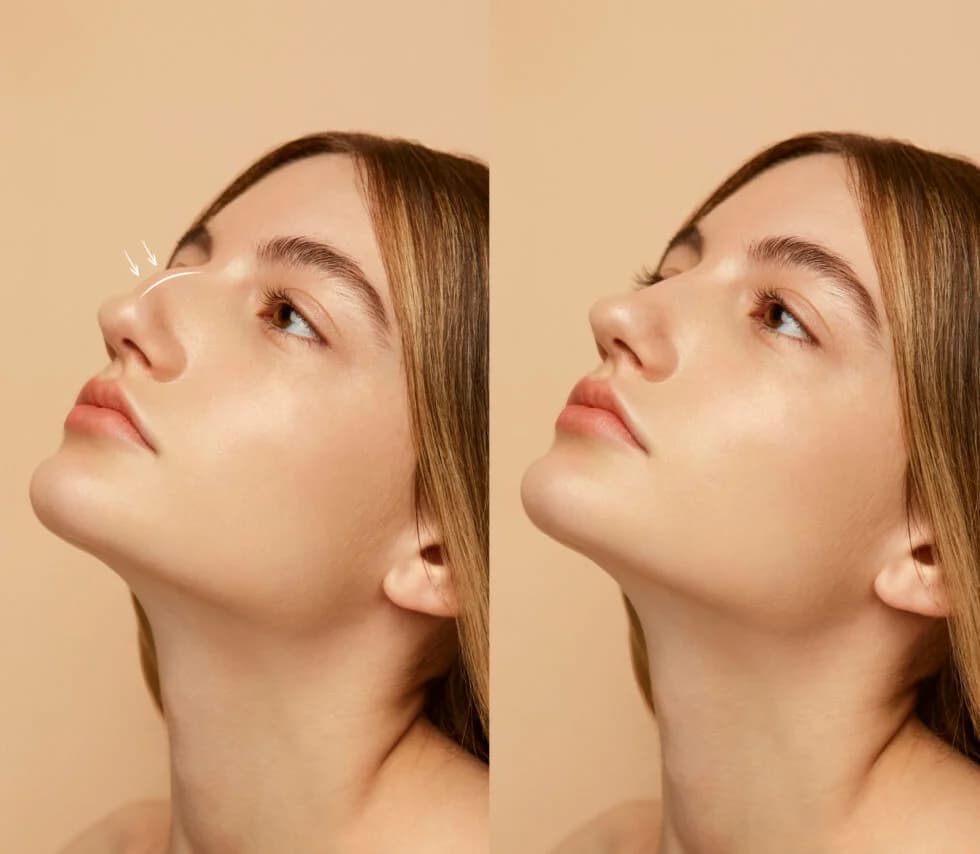 Rhinoplastie