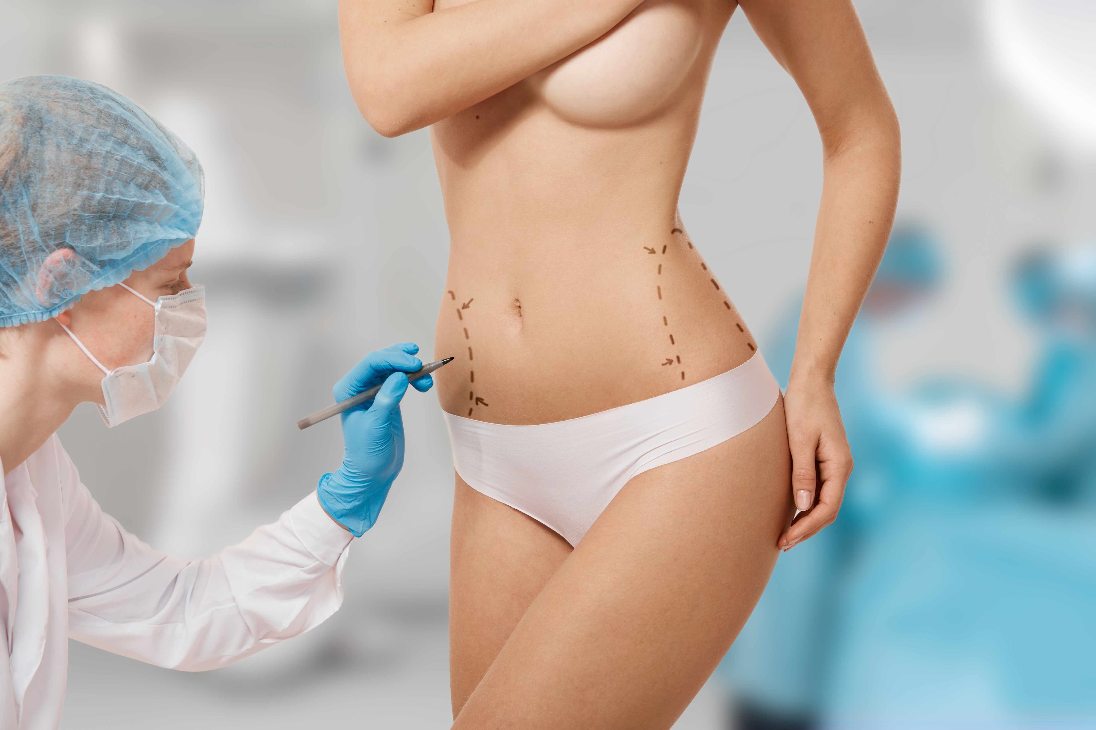 Liposuccion des flancs