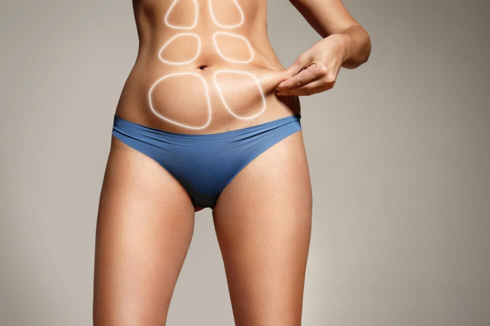 Abdominoplastie