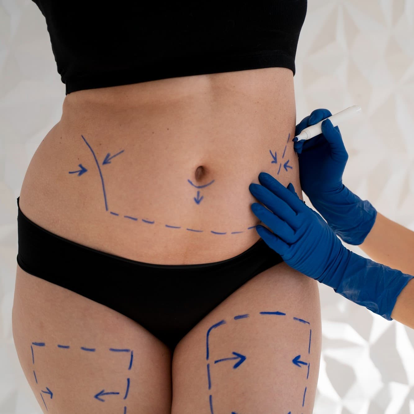 Chirurgie de l'obésité