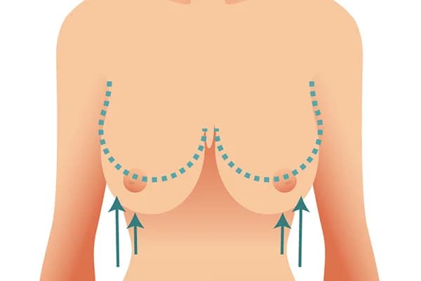 Lifting des seins avec prothèse