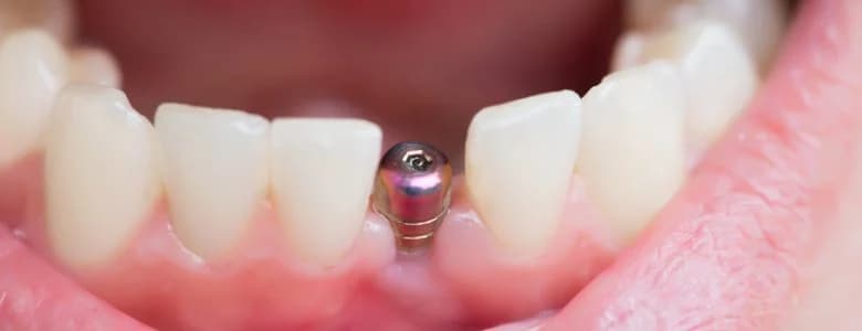 Implant dentaire