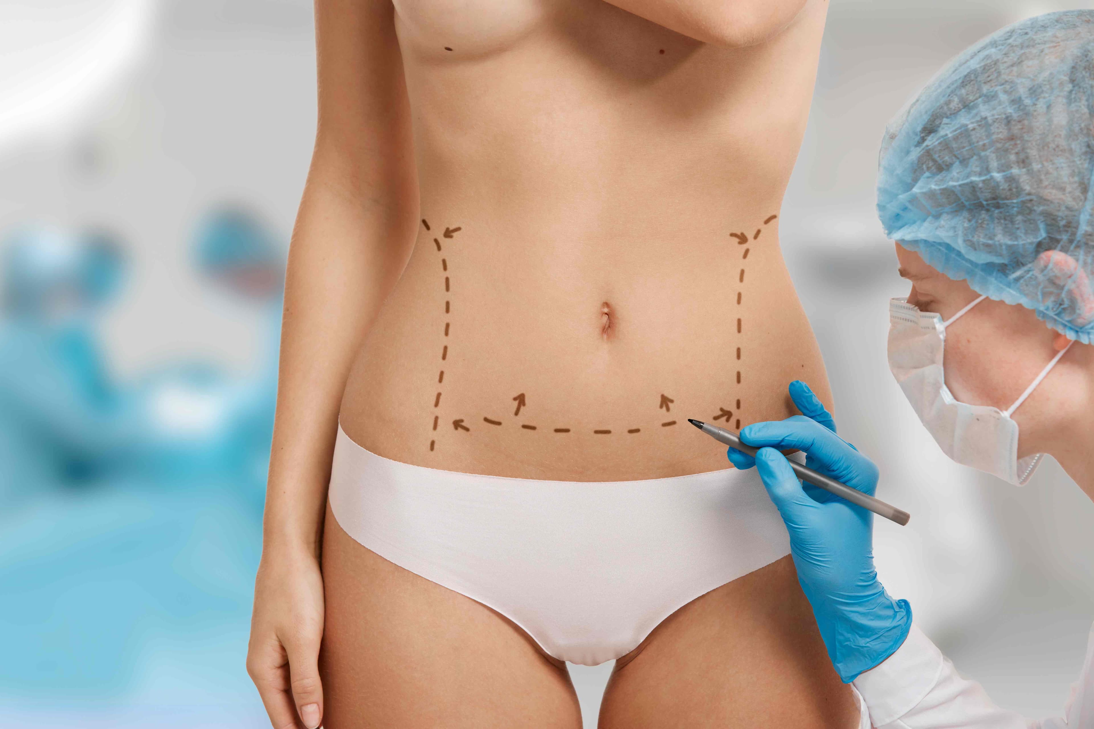 Liposuccion abdomen