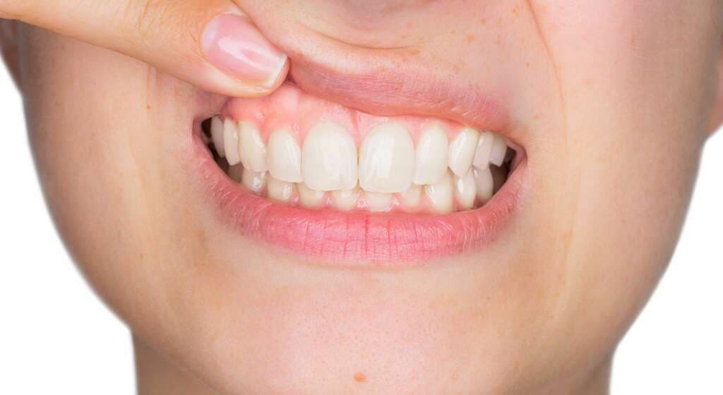 Gingivectomie