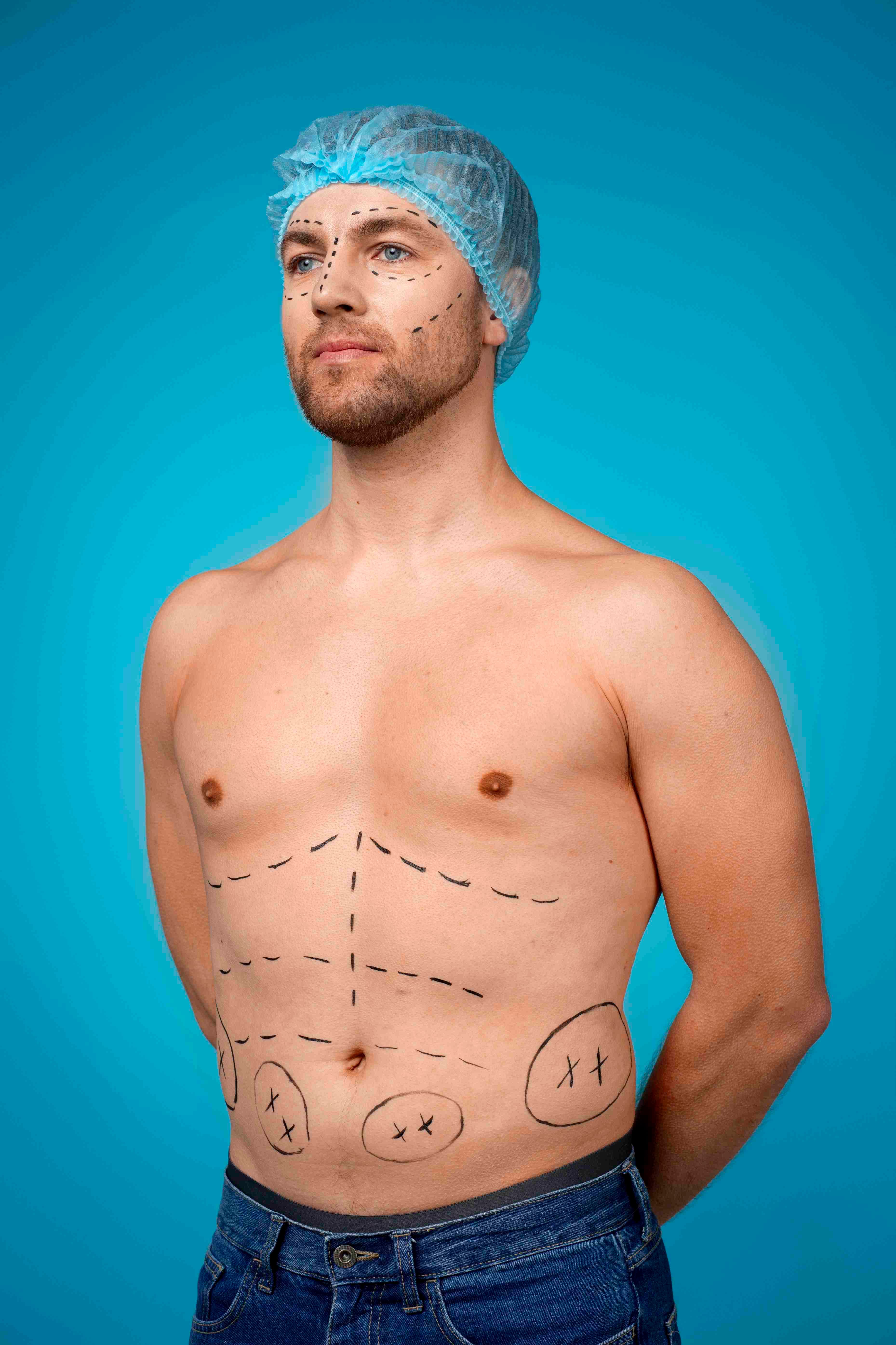 Liposuccion des flancs