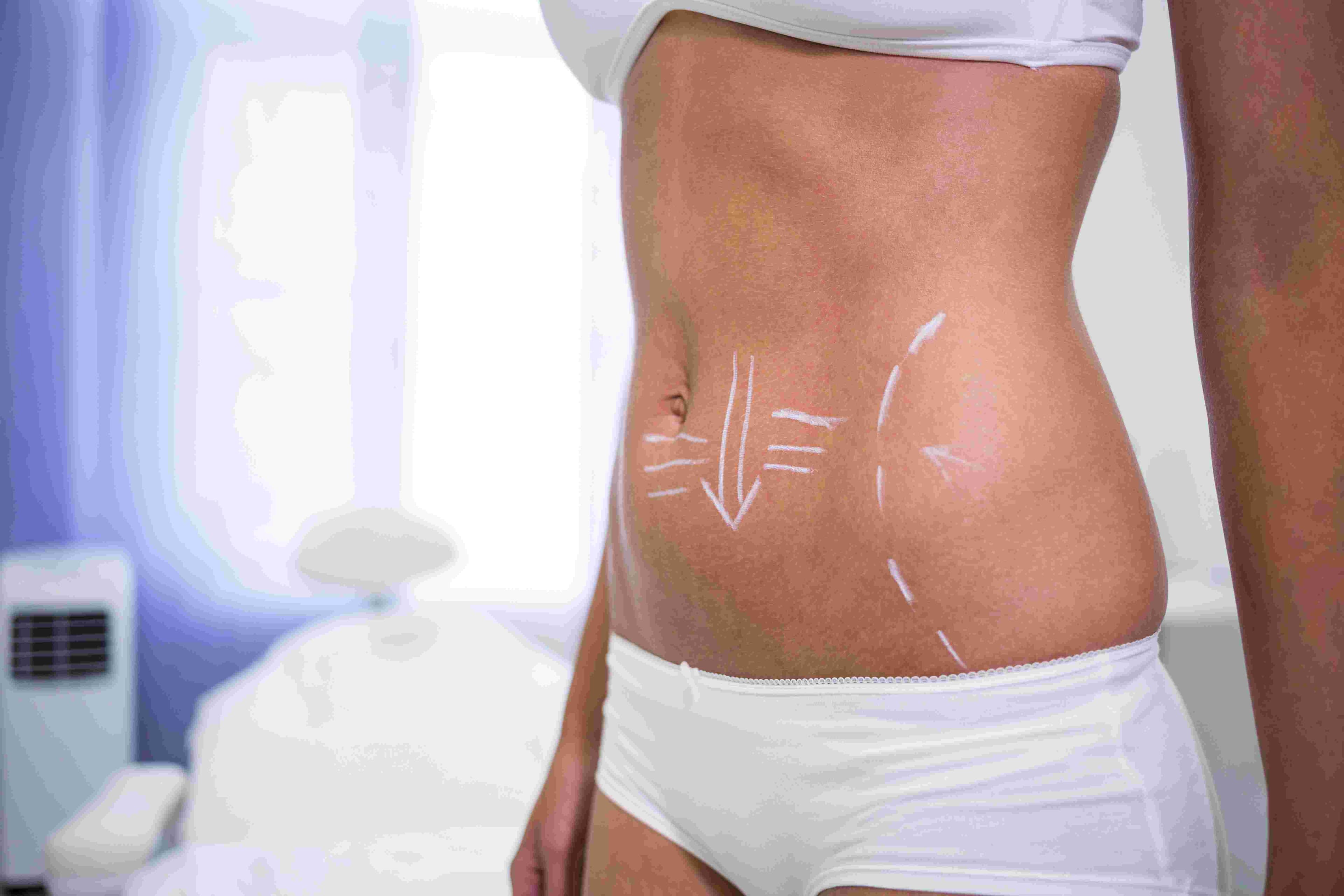Abdominoplastie avec liposuccion complète