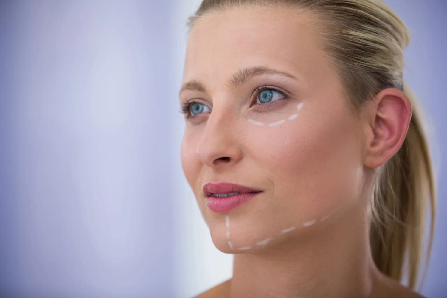 Lifting cervico-facial
