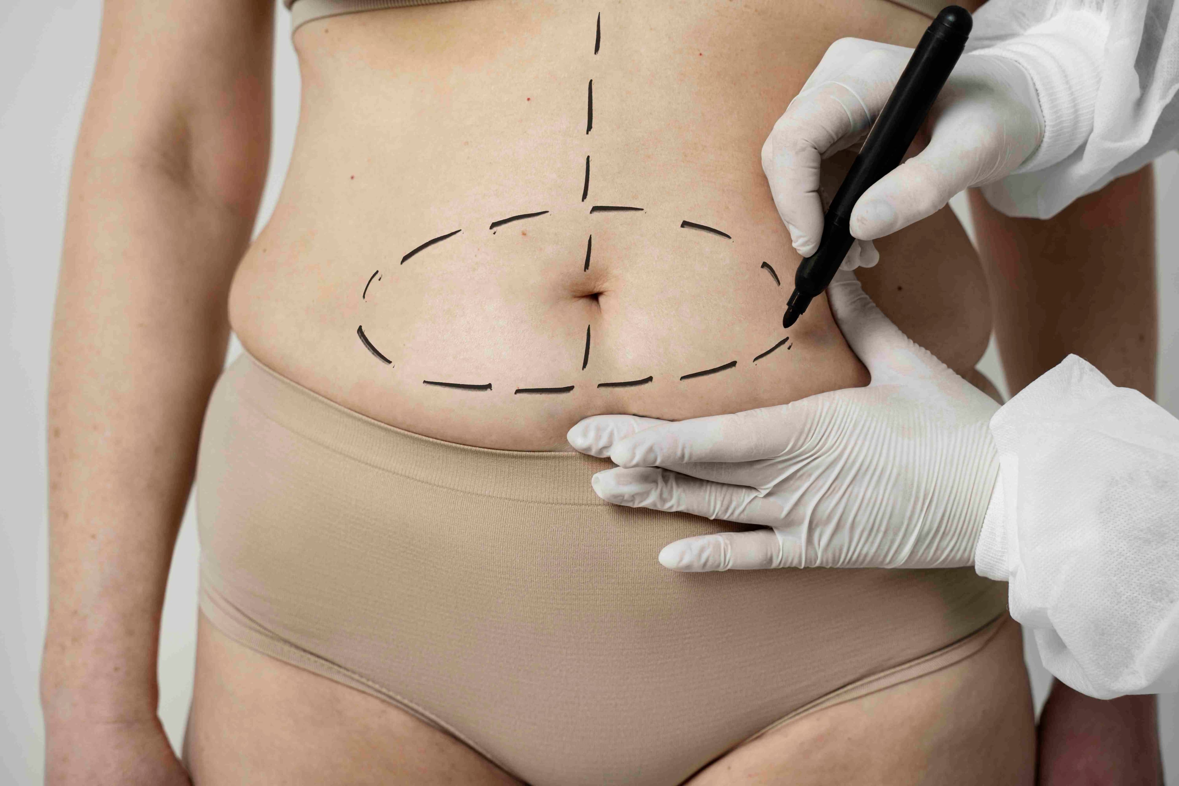 Abdominoplastie avec liposuccion du ventre