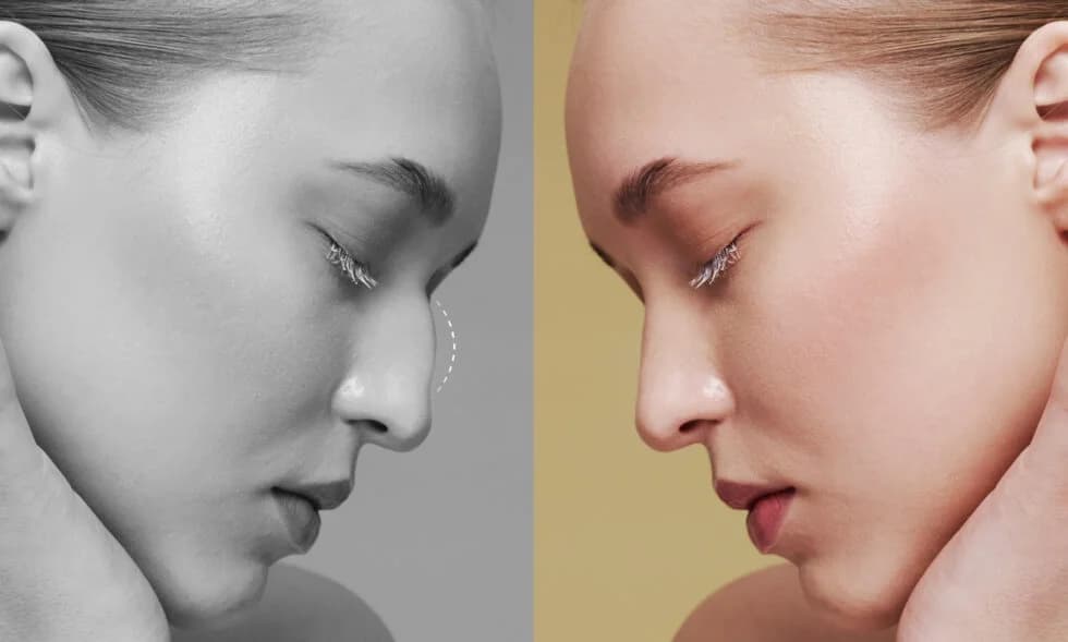 Rhinoplastie