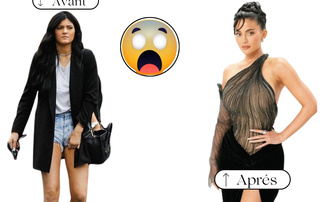 Chirurgie Esthétique de Kylie Jenner